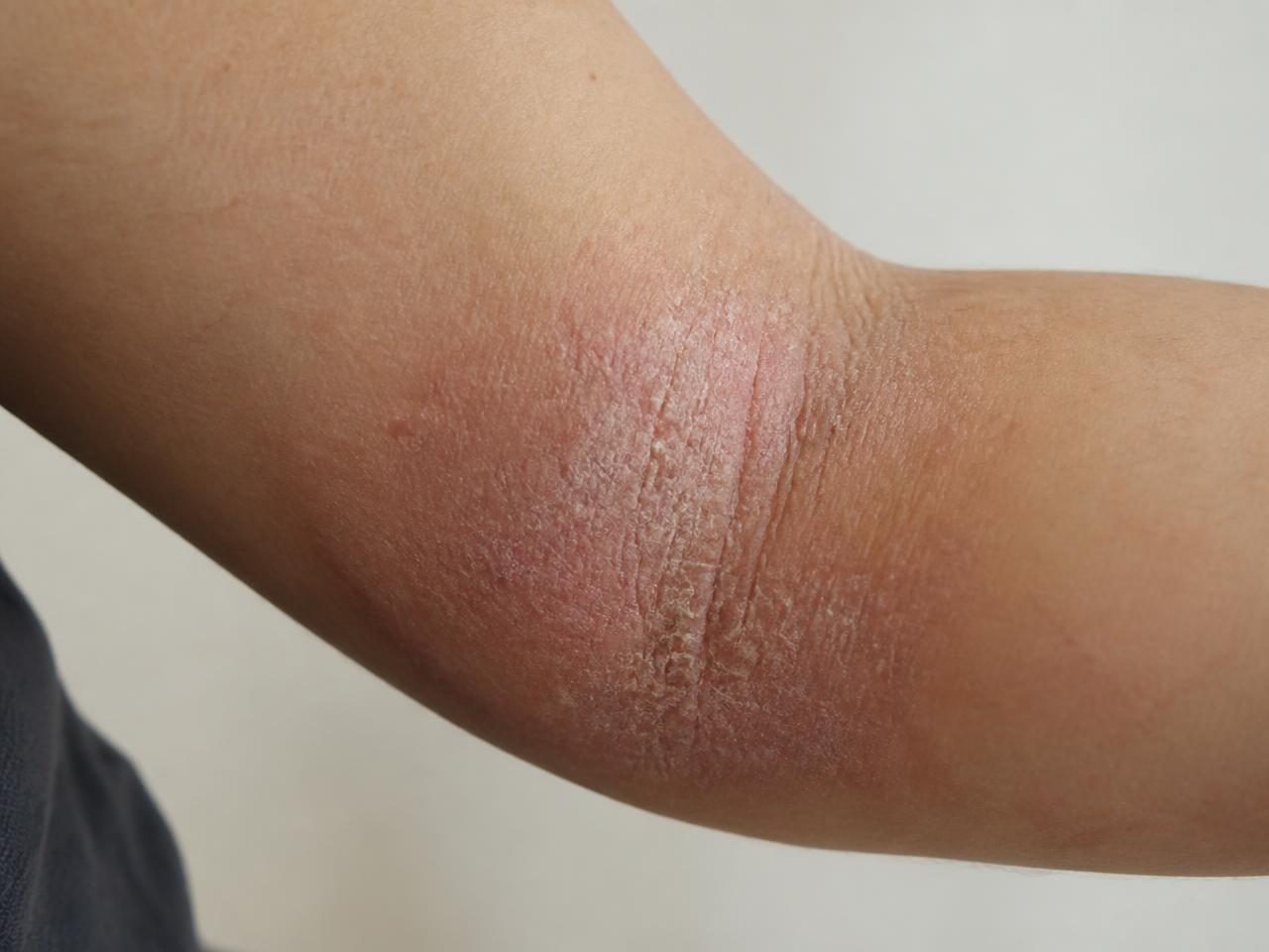 Dry, inflamed eczema patch at the inner elbow