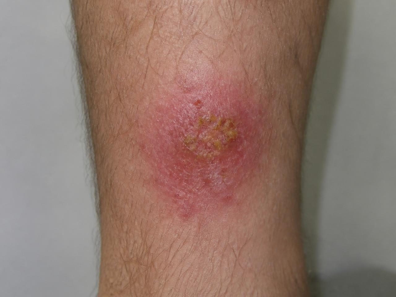 Localized skin infection with redness and light crusting on the lower leg