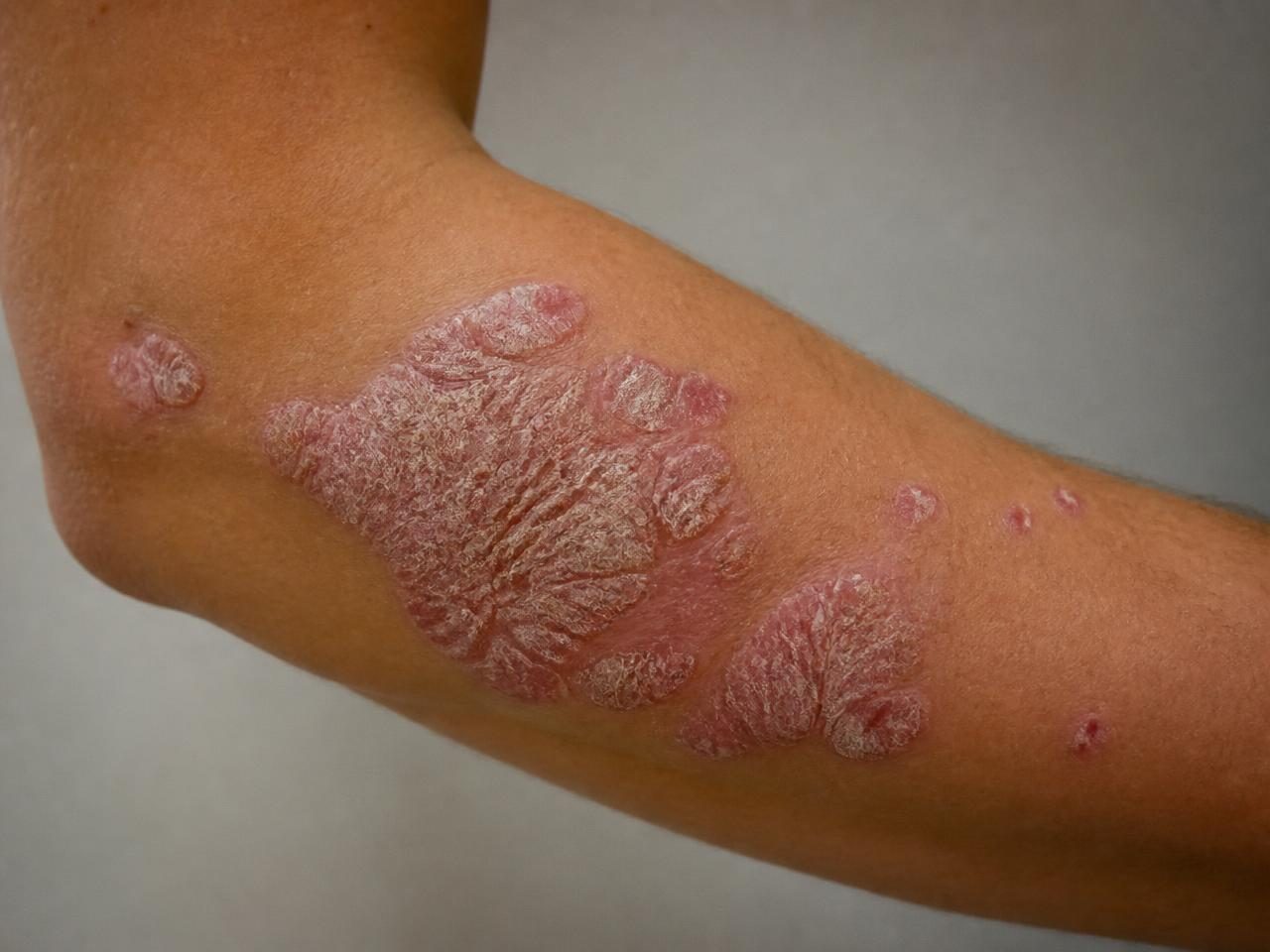 Scaled psoriasis plaques on an elbow