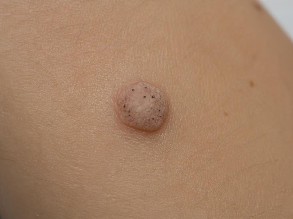 Raised common wart on skin with rough surface and tiny black dots