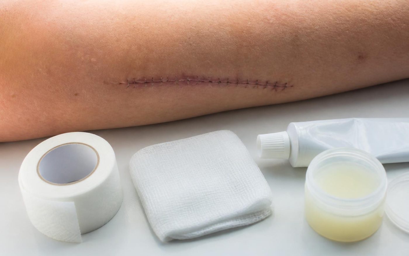 Healing sutured excision site on a forearm with tape, gauze, ointment and scar gel for aftercare