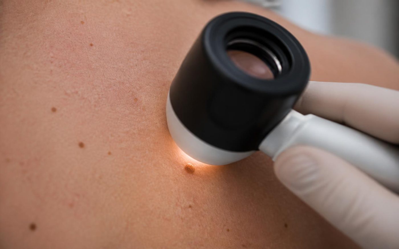 Dermatoscope held against the upper back to examine a small mole during a full-body skin exam
